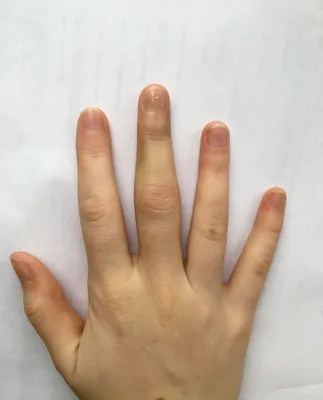 Перелом пальца на руке: изображение для диагностики