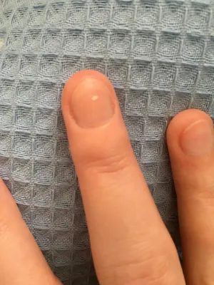 Фото перелома пальца на руке с разными ракурсами