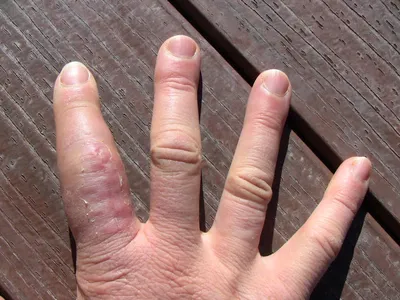 Фотография перелома пальца на руке с высоким разрешением