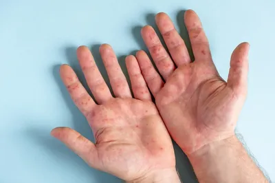 Фотографии рук с пятнами: лучшие изображения для скачивания