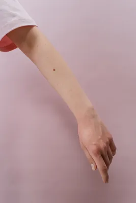 Фотография руки с пигментацией и розовой кожей