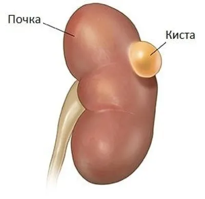 Доброкачественная опухоль почки - симптомы, диагностика, лечение и удаление  в Москве