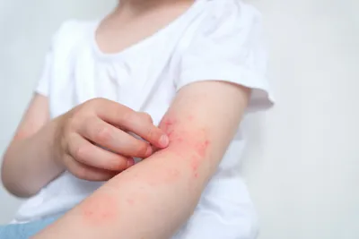 Изображение покраснения кожи на руках при аллергии