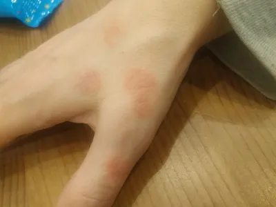 Фотография покраснения кожи на руках от укусов насекомых