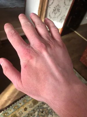 Фото покраснения кожи на руках при заболеваниях печени