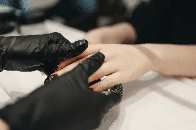 Фотография покраснения кожи на руках при болезни Крона