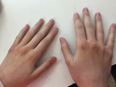 Изображение покраснения кожи на руках при гипертонии
