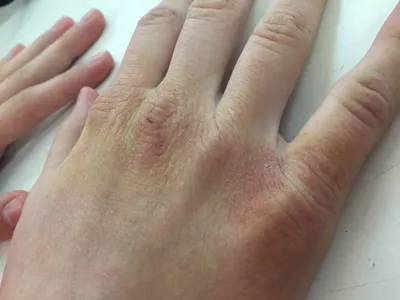 Фотка покраснения кожи на руках при сердечной недостаточности