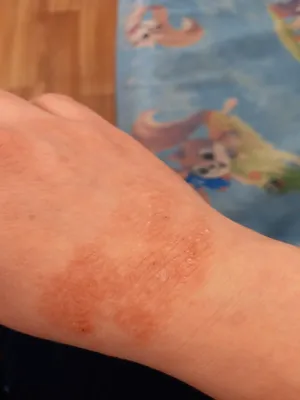 Фотка покраснения кожи на руках при нарушениях иммунной системы