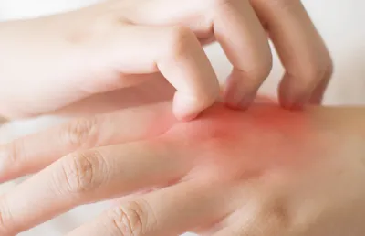 Раздражение кожи на руках: фото для лечения