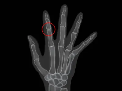 Изображение заболевания полиартритом пальцев рук