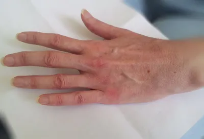 Фото диагностики полиартрита пальцев рук