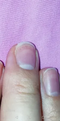 Изображение полос на ногтях рук на разных типах ногтевой пластины