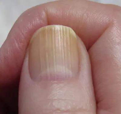 Фото полос на ногтях рук на разных типах накладных ногтей