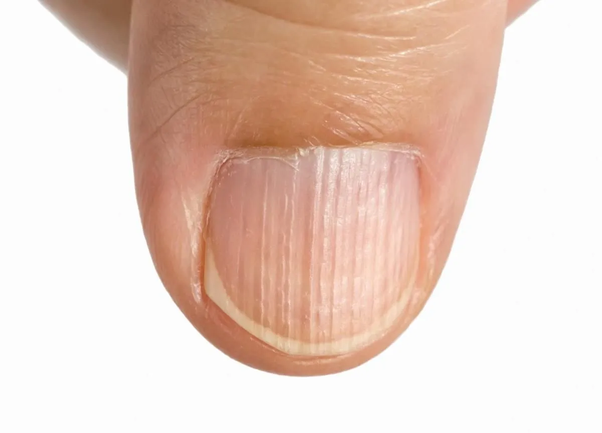 Полосы на ногтях вертикальные о чем. Ониходистрофия - онихолизис.. Поперечные борозды бо-Рейли. Борозды бо-Рейля (линии бо). Бо–Рейли борозды ногти.