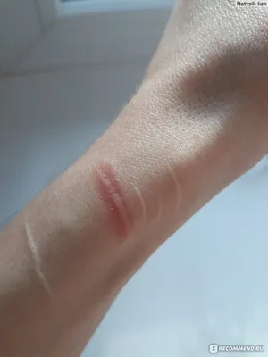 Фотографии порезов на руках: как правильно наложить бинт