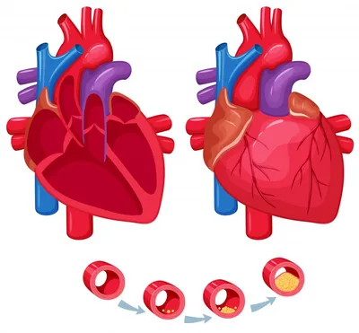 Пороки сердца: причины, симптомы, виды, лечение и прогноз - Belhope  Consulting