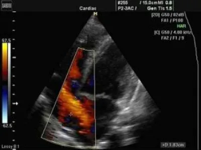 Аортальный порок сердца - причины, симптомы, диагностика и лечение, прогноз