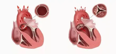Врожденный и приобретенный порок сердца: чем отличаются и как лечить