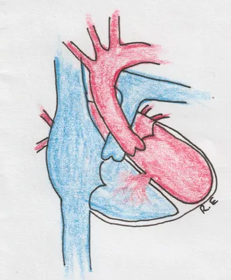 Врожденный порок сердца: Тетрология Fallot Иллюстрация вектора -  иллюстрации насчитывающей проблема, медицинско: 197974420