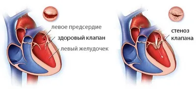 Приобретенные пороки сердца: лечение, операция на сердце - цена в СПб