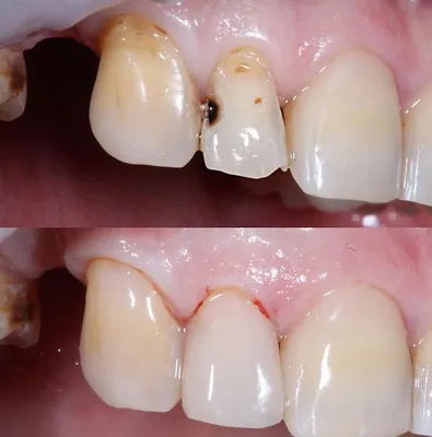Реставрация зубов (фото до и после) - Работы стоматологов Центра  Стоматологии и Имплантологии