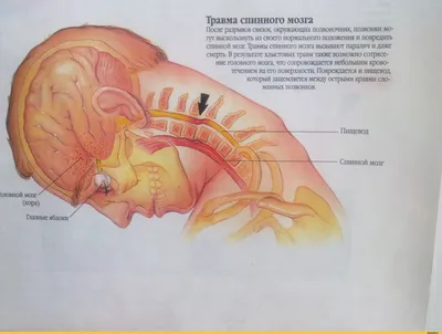 Остеохондроз грудного отдела позвоночника - Стержень