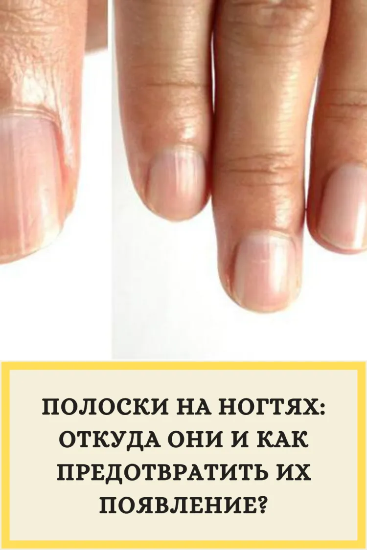 Продольные полоски на ногтях