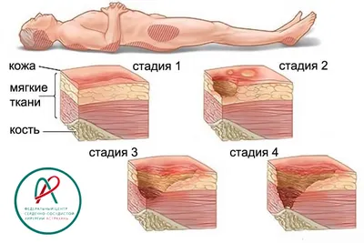 Пролежни картинки фотографии