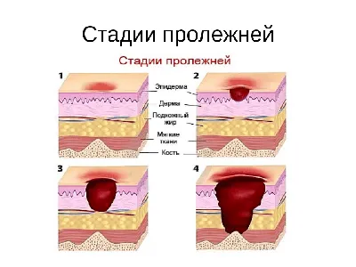 Волгоградку выписали из больницы с гниющими пролежнями: семья требует  проверить врачей