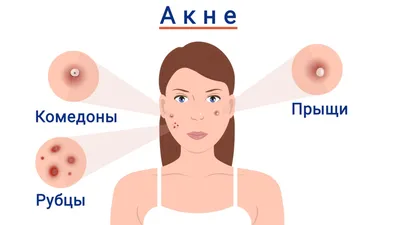 Акне прыщи на лице - причины, лечение в домашних условиях без антибиотиков  и мазей - Университет здорового ребёнка Няньковских