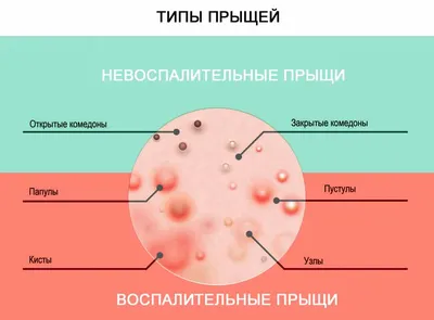 Прыщи на лице [угри, высыпания] — причины, виды акне, что делать