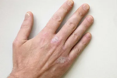Увеличенное изображение псориаза на кистях рук