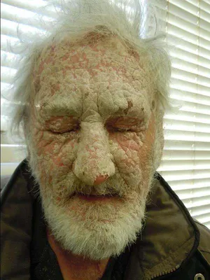 Псориаз на лице — фото, симптомы и лечение