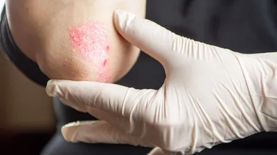 Dermaquest Skin Therapy - #ЭкземаЛица - хроническое воспалительное  заболевание кожи аллергической природы с зудом, преимущественно пузырьковой  сыпью и склонностью к рецидивам (повторениям процесса). Виды экземы,  которые чаще всего бывают на лице:⠀ ▫ #