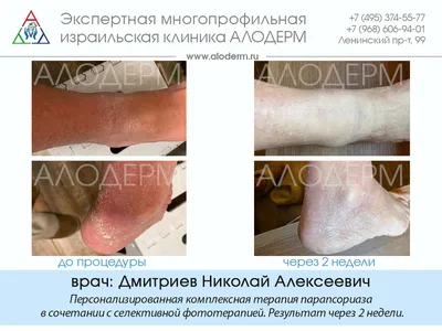 Крем Скин-Кап для лечения аллергических заболеваний кожи - «Крем Скин-Кап в  комплексном лечении псориаза. Стоимость, эффективность, результат  применения на лице.» | отзывы
