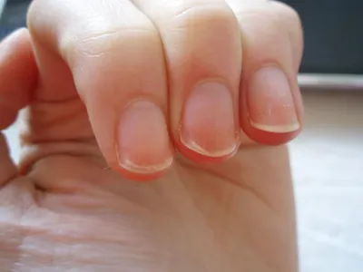 Фотография псориаза на ногтях рук: редкий случай