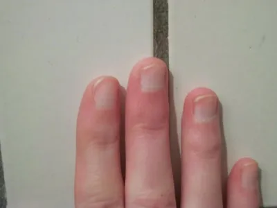 Фото псориаза на ногтях рук: отличное качество