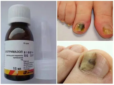 Псориаз на ногтях рук: фото для лечения