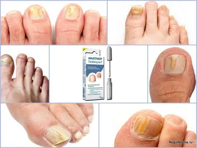 Изображение псориаза на ногтях рук: важный диагностический материал