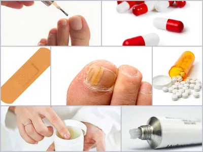 Картинка псориаза на ногтях рук: пример заболевания