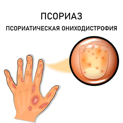 Картинка псориаза на ногтях рук для скачивания