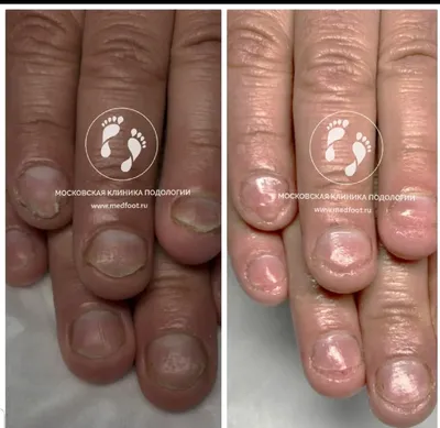 Псориаз на руках: фото с нарушением целостности кожи