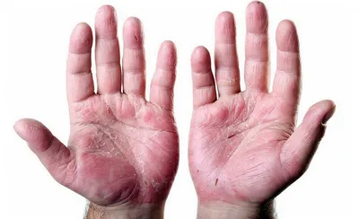 Фотография псориаза на руках: какие побочные эффекты могут быть у препаратов