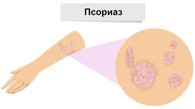 Фото псориаза на руках: какие причины могут вызвать обострение