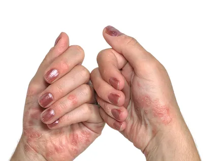 Псориаз рук: изображение для диагностики