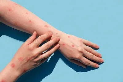Псориаз рук: фото для медицинских целей
