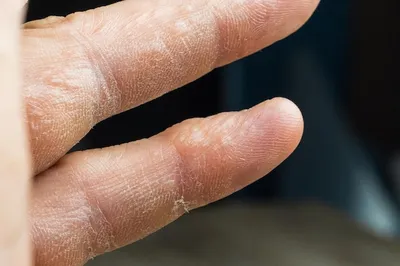 Изображение псориаза на руке для пациентов