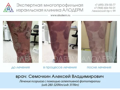 Фото псориаза на руках: Психологические последствия