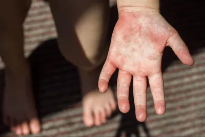 Фотография пупырышек на руках после контакта с аллергеном